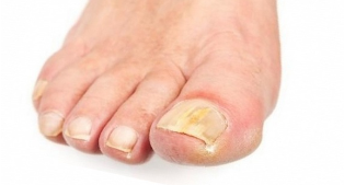 Fungus of the nail